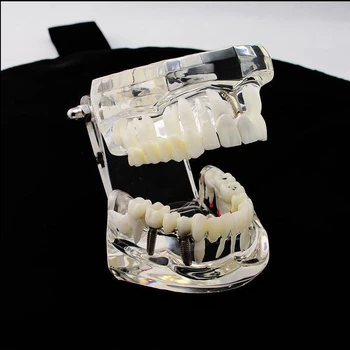 1 Vnt Dantų Implantai Dantų Modelį, Kuriame Restauravimo Tiltas Medicinos Mokslo Stomatologas Mokymo Studijų