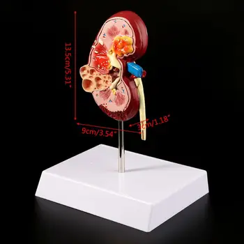2020 Naują Gyvenimą Dydis Sergančio Žmogaus Anatomijos Modelis Anatomija Ligonių Patologinių Akmens Organų Mokymo Reikmenys