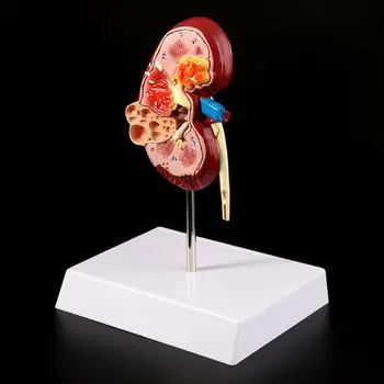 2020 Naują Gyvenimą Dydis Sergančio Žmogaus Anatomijos Modelis Anatomija Ligonių Patologinių Akmens Organų Mokymo Reikmenys