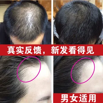 OMENFEE Galingas serumas plaukų augimą, apsaugo nuo plaukų slinkimo storesnis eterinis aliejus, siekiant užkirsti kelią plaukų augimą Plaukų slinkimo Serumas